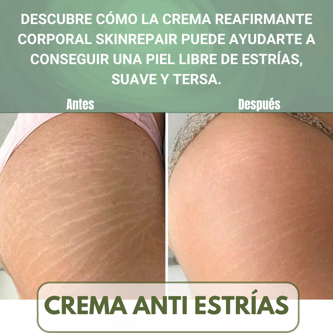 Piel Perfecta – Crema Antiestrías para Todo Tipo de Piel